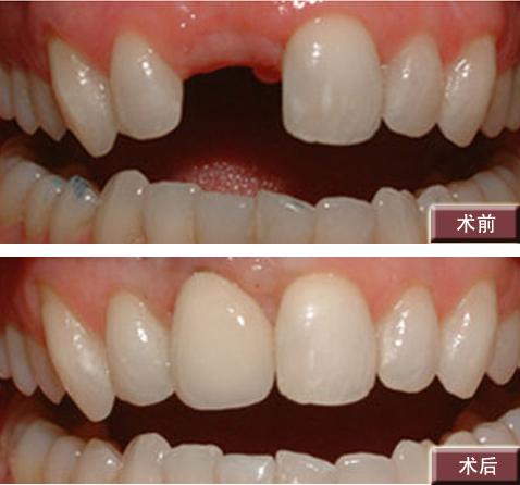 牙槽嵴裂植骨修复