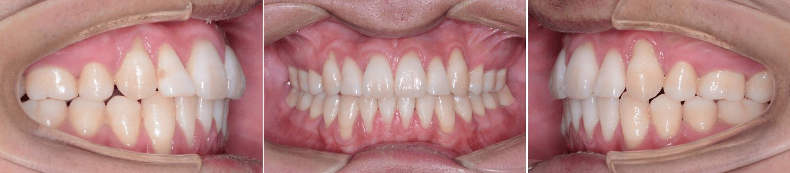 牙龈萎缩正畸结束后是否会有所改善？
