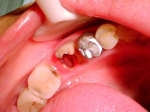 残根牙治疗方法;残根牙怎么治疗