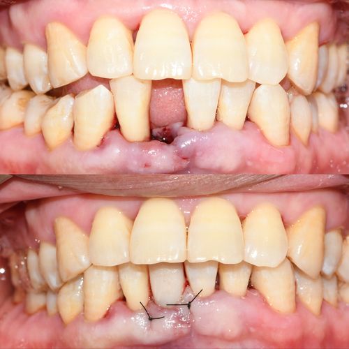 牙槽嵴裂植骨修复