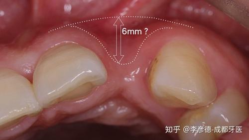 骨粉填充牙龈多久恢复_骨粉填充牙龈多久恢复：专家解答