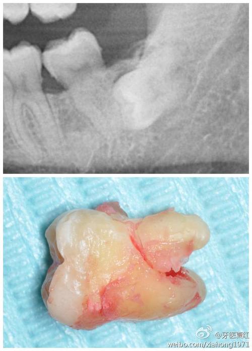 骨性埋藏阻生牙是什么、骨性埋藏阻生齿