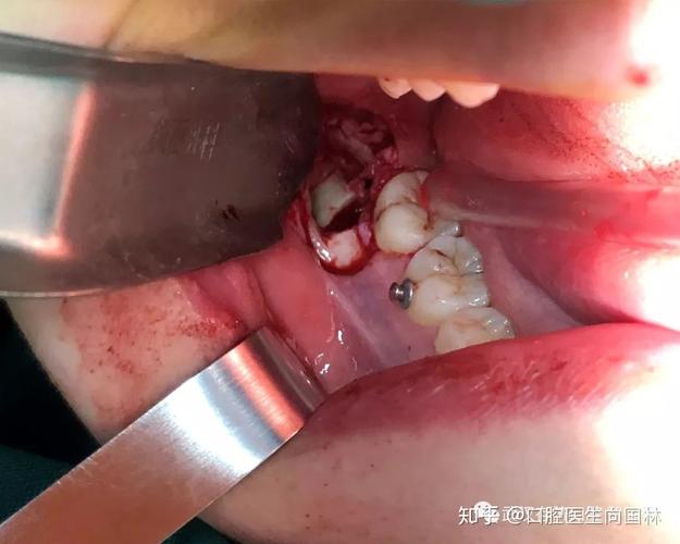 骨性埋藏阻生牙拔除术