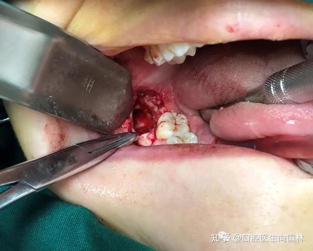 骨性埋藏阻生牙拔除术