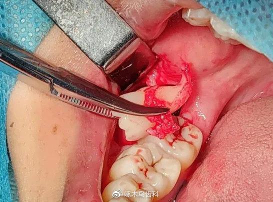 骨性埋藏阻生牙是什么