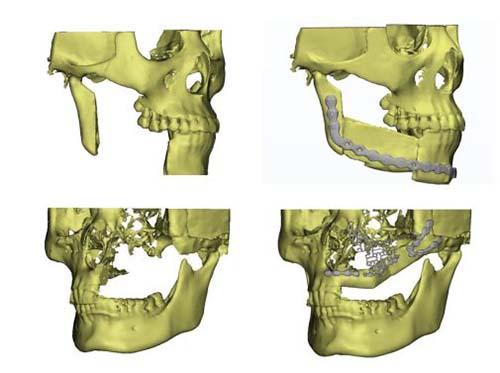 颌面缺损修复是什么意思、颌面缺损修复解析
